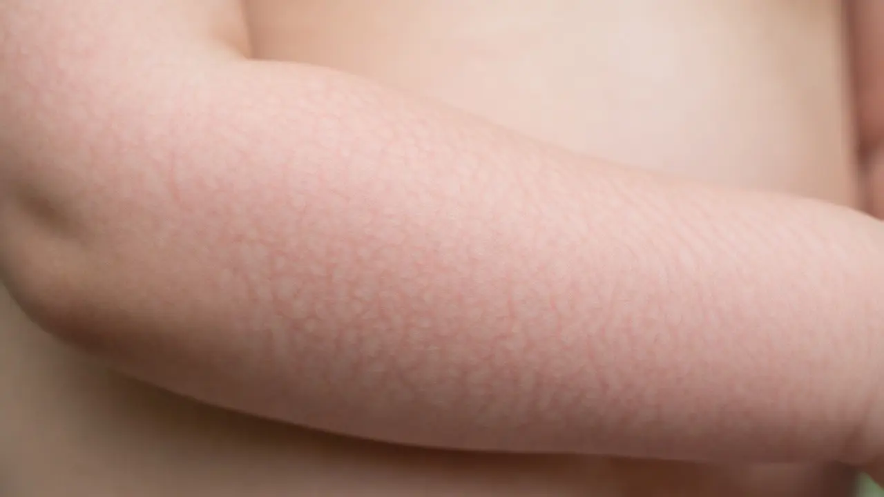 Detailní pohled na jemnou síťovanou vyrážku na kůži dítěte